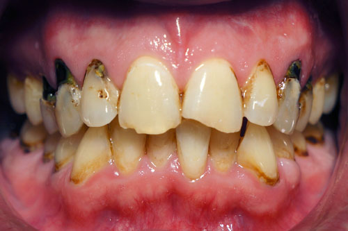 Before and After - Enamel Dental | Yaletown Dentistry